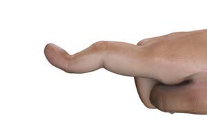 Boutonniere Deformity 